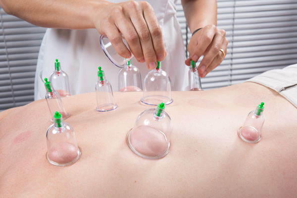 Cupping Therapy
